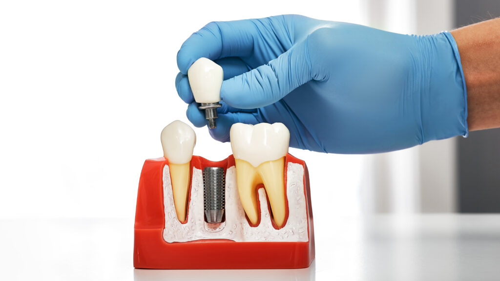 Dental Implant at GDC Dental Care Image